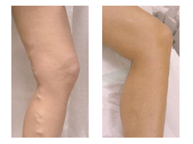 Before and After Photos for EVLT