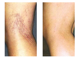 Before and After Photos for Laser Treatments
