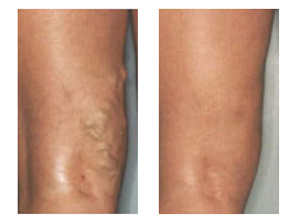 Before and After Photos for VNUS Closure Procedure