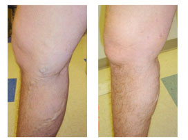 Before and After Photos for VNUS Closure Procedure