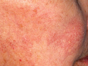 Before and After Photos for VeinGog