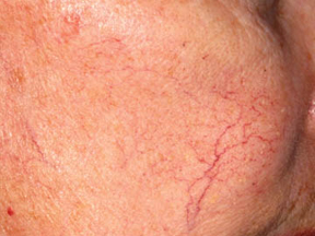 Before and After Photos for VeinGog