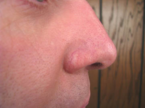 Before and After Photos for VeinGog