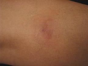 Before and After Photos forVeinGog