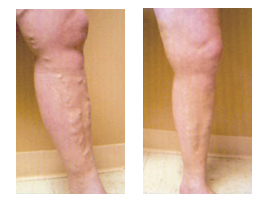 Before and After Photos for Sclerotherapy