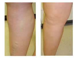 Before and After Photos for Ambulatory phlebectomy