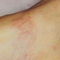Before and After Photos for Veinwave