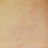 Before and After Photos for Veinwave