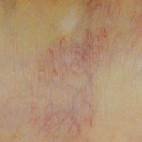 Before and After Photos for Veinwave