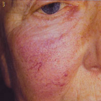 Before and After Photos for Veinwave
